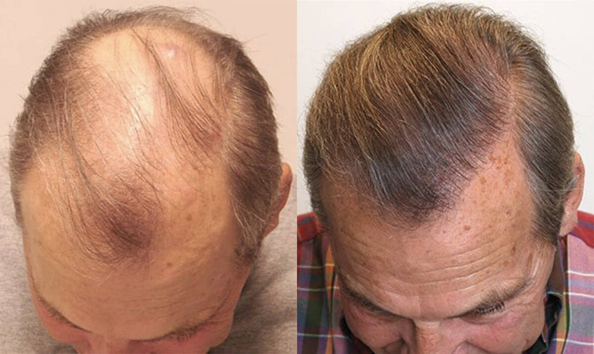 Crown and temples, before and after