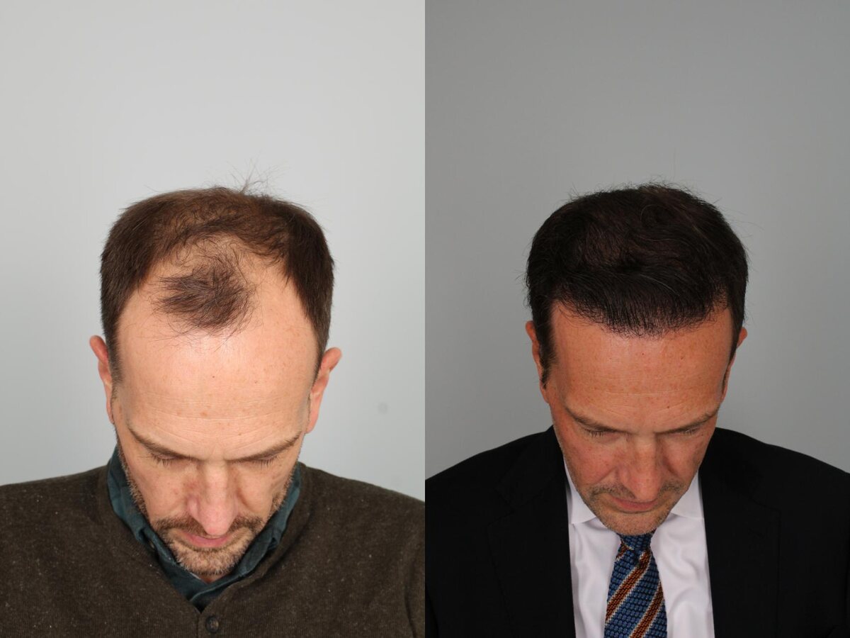 Hairline restored, before and after