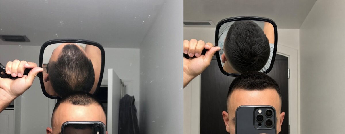 Back of the head, before and after