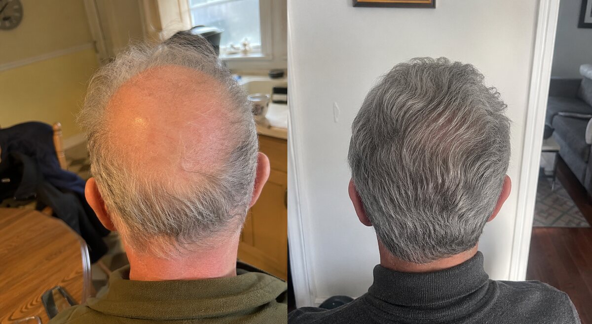 A full head of hair again, before and after