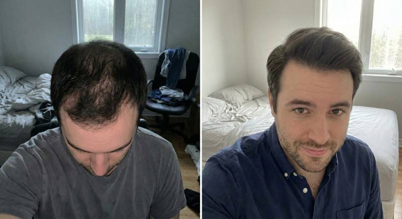 Before-and-after hair progress comparison
